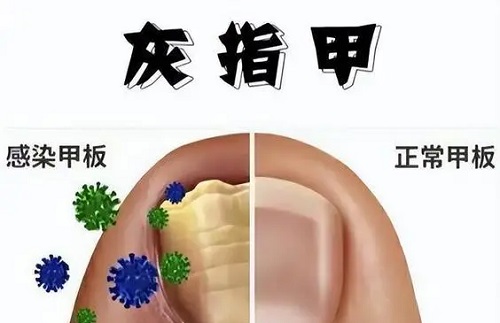 醋精能治疗灰指甲吗