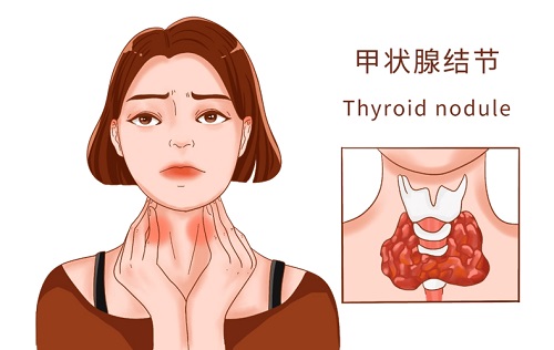 甲状腺结节的形成原因是什么