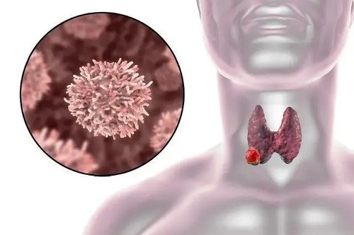 甲状腺结节会引起哪些身体不适