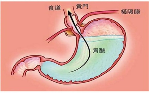 胃酸过多建议吃什么食物