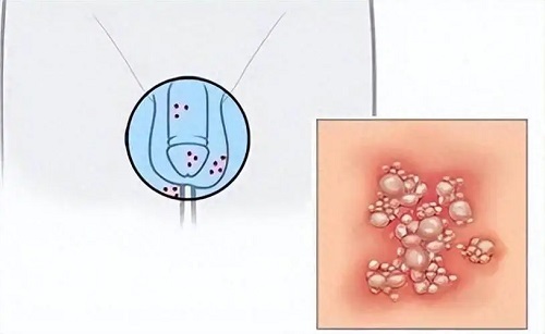 生殖器疱疹不能吃的食物有哪些