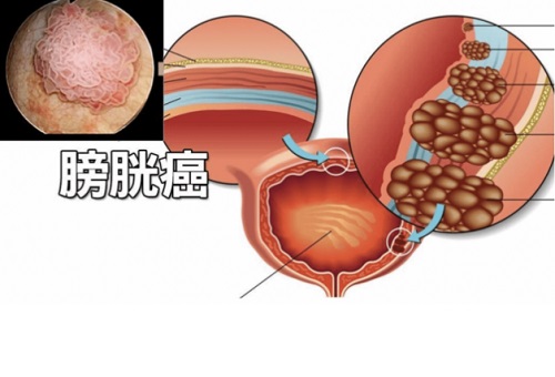 男人更容易有膀胱癌是什么原因