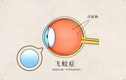 飞蚊症会导致失明吗