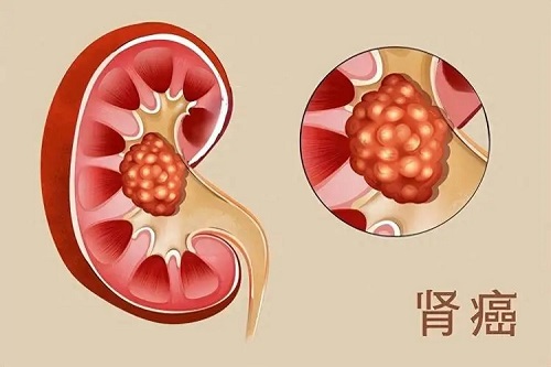 肾癌患者的饮食禁忌有哪些