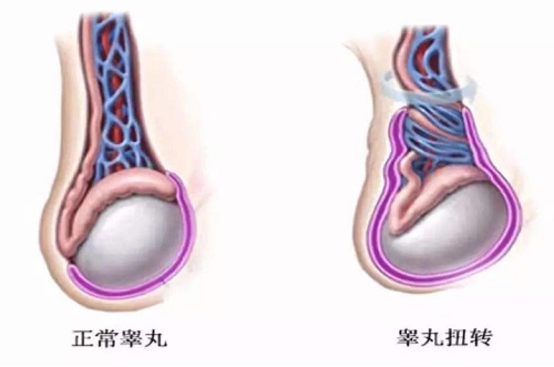 睾丸扭转最佳治疗时间是什么