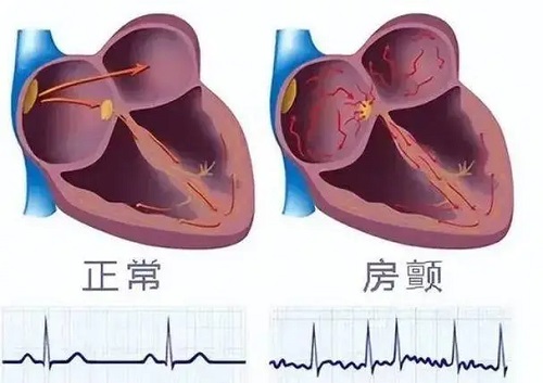 房颤的三大症状是什么