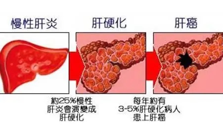 肝癌为什么是穷人癌