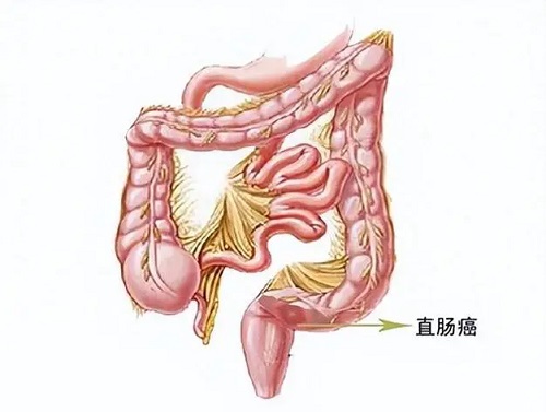 结肠癌手术后遗症有哪些