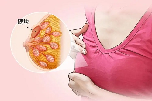 女性乳房有硬块如何治疗