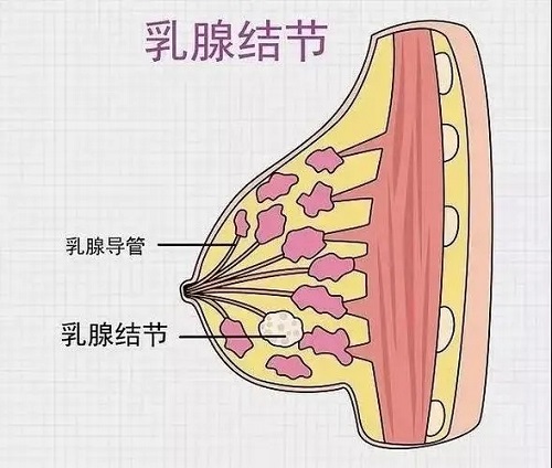 吃芋头对乳腺结节有好处吗 七天消除乳腺结节怎么做