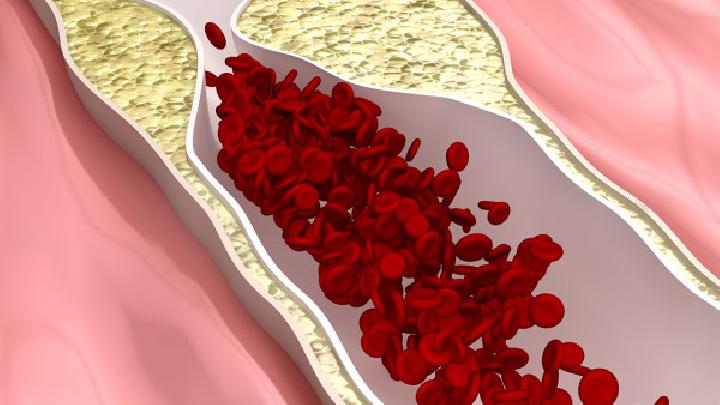 动脉硬化治疗最佳方法是什么
