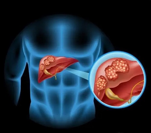 肝癌会传染吗 肝癌早期哪里痒